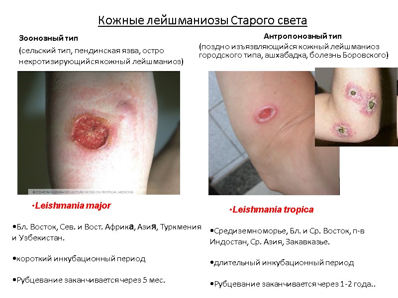 Кожные лейшманиозы Старого света  Зоонозный тип  (сельский тип, пендинская язва, остро некротизирующийся